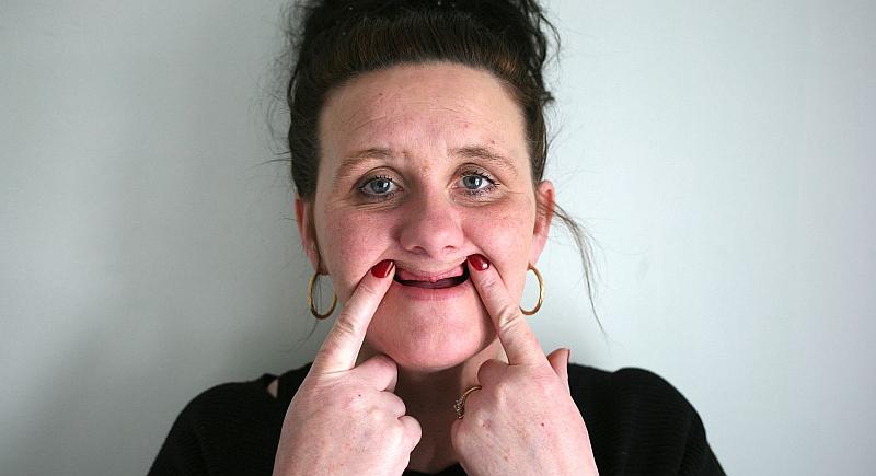 Nije znala njemački: zubar joj umjesto popravka jednog izvadio 16 zuba