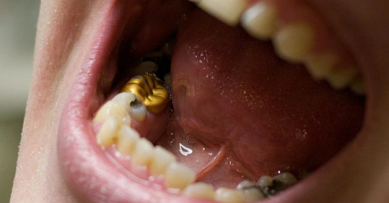 TA SE NE BOJI ZUBARA Hrvatska državljanka  u Austriji krala zlato za zube, oštetila zubare za oko 10.000 eura