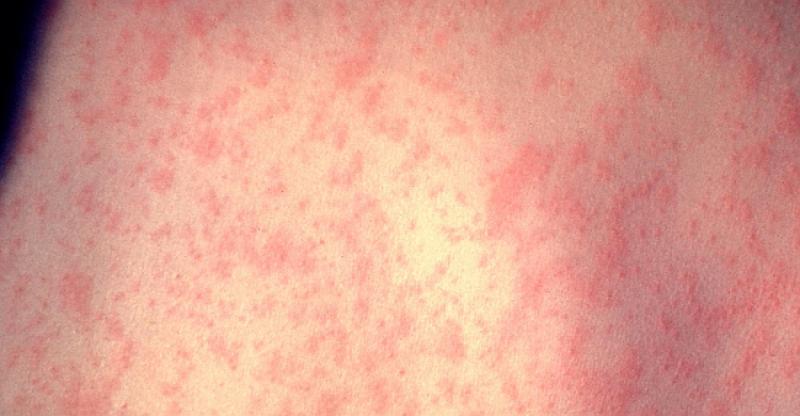 EPIDEMIJA OSPICA NA SJEVERU BIH Sve više zaraženih, sud počeo kažnjavati roditelje koji ne cijepe djecu