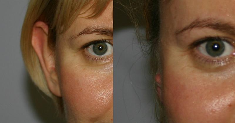 'KLEMPAVE' UŠI Stručnjak nam otkriva sve što trebate znati o njima i kako ih se lako može korigirati