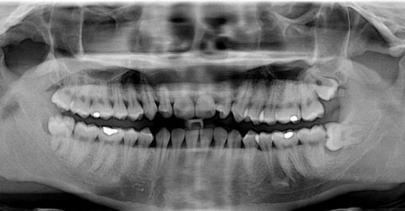 NEVJEROJATNO Njemački zubar izvadio Hrvatu zub veličine 37,2 milimetra